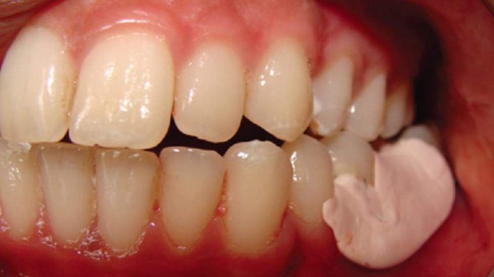 در صورت افتادن پانسمان بین جلسات عصب‌کشی، چه اقداماتی لازم است؟